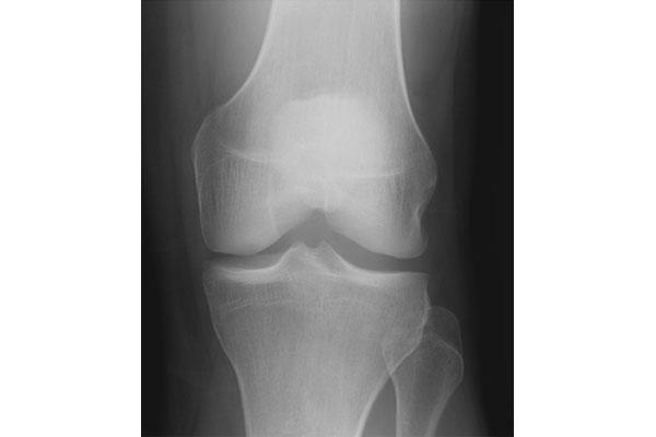 normal radiograph of the left knee
