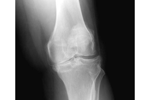 Radiograph of advanced degenerative disease