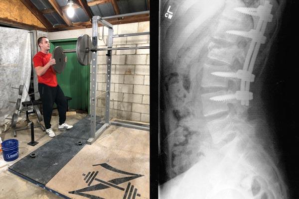 joe barbell training spinal fusion