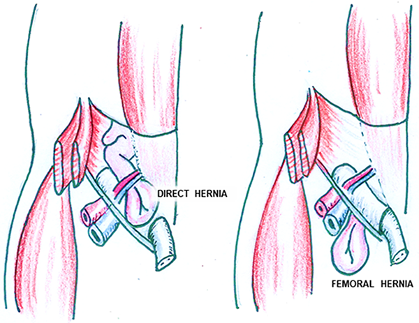 direct hernia and femoral hernia illustrations