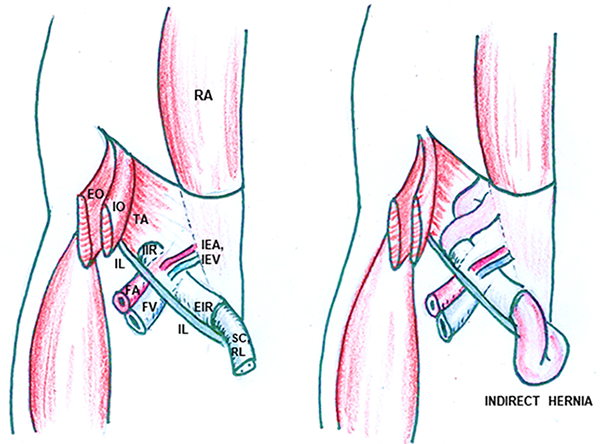 groin anatomy and indirect hernia illustrations