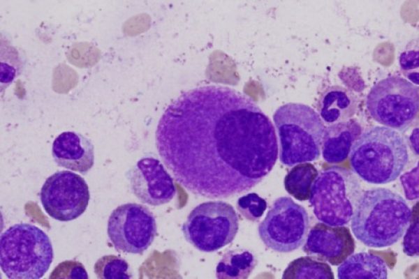 leukemia