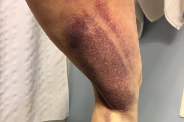 bruising after a muscle tear