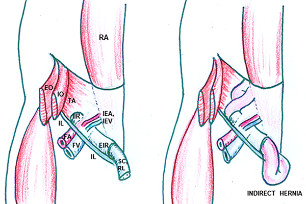 groin anatomy and indirect hernia illustrations
