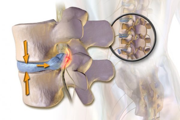 herniated disc