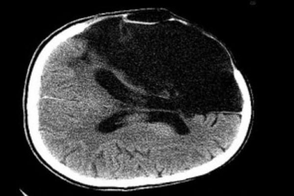 strength training stroke recovery