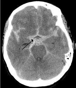 Cranial computed tomographic (CT) image of a patient with subarachnoid hemorrhage