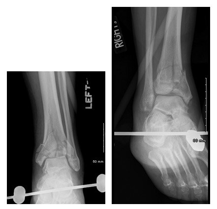 x-rays and pins